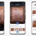 Google Lens Now Identifies Skin Issues via Picture Recognition